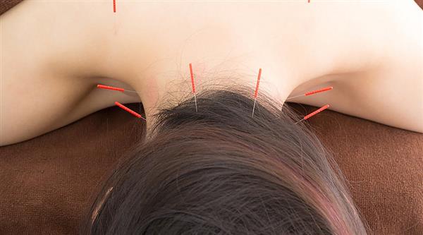 中醫(yī)針灸有何療效？石家莊炎黃針灸推拿學校為你分享！